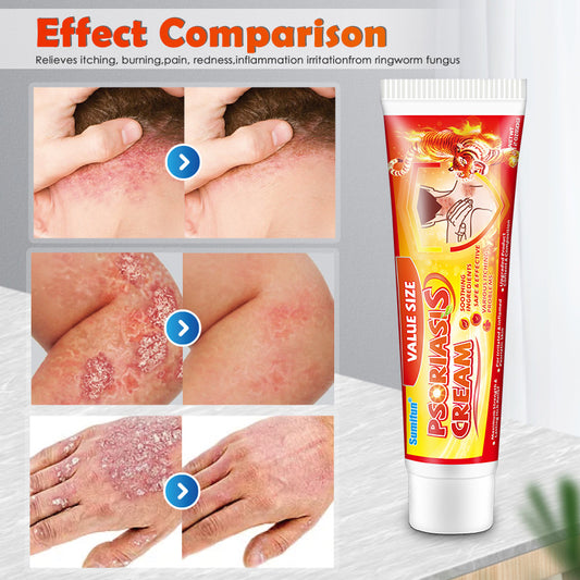 Skin Itching cream